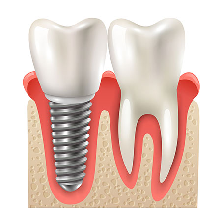 Ejemplo implante dental Clínica Dentistas Granada