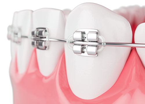 Ortodoncia en Granada Brackets Clinica Dental