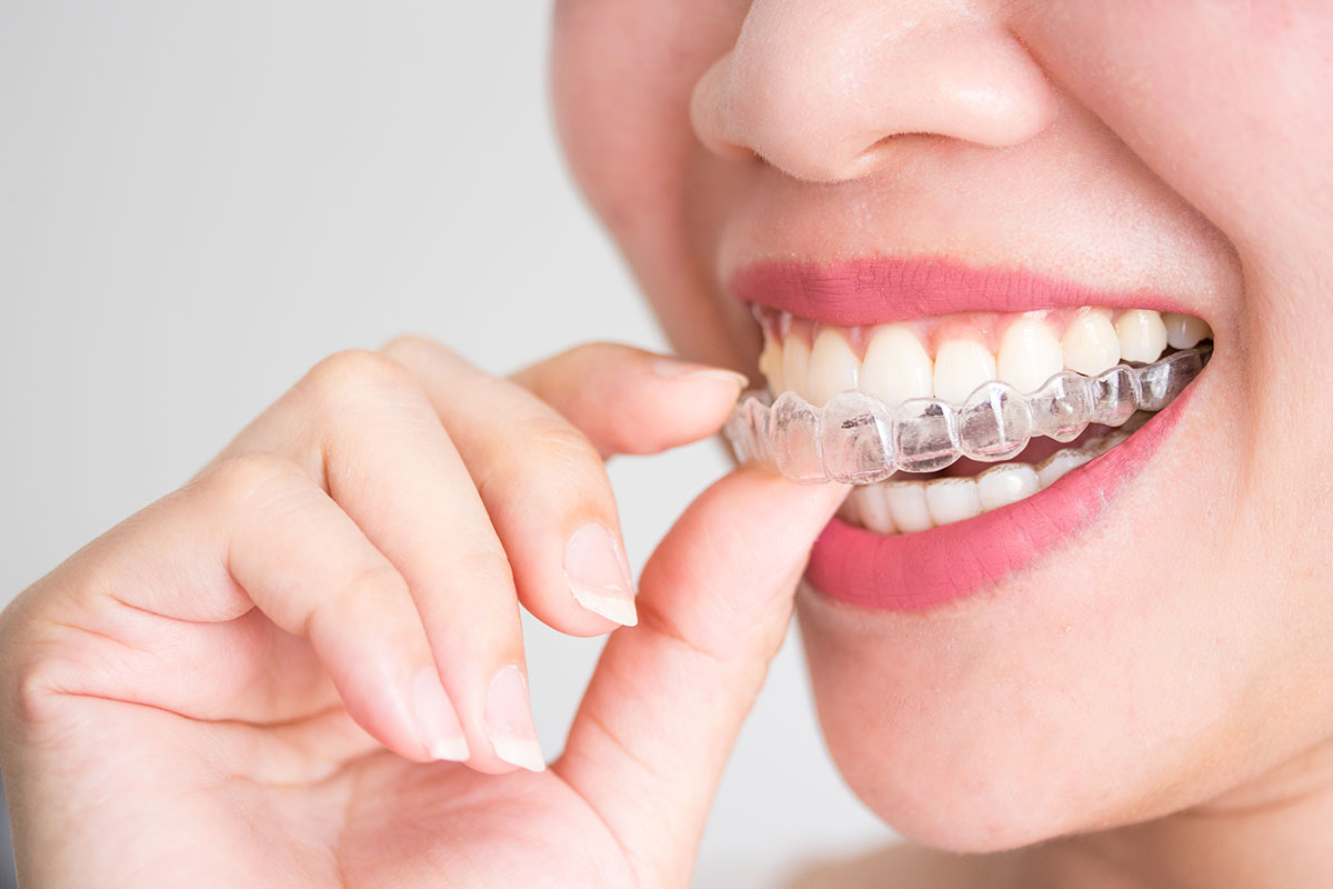 Invisalign Ortodoncia Invisible Granada Clinica Dental